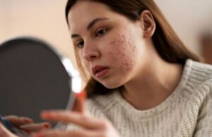 Aknet në trup, gjashtë mënyra për t’i parandaluar